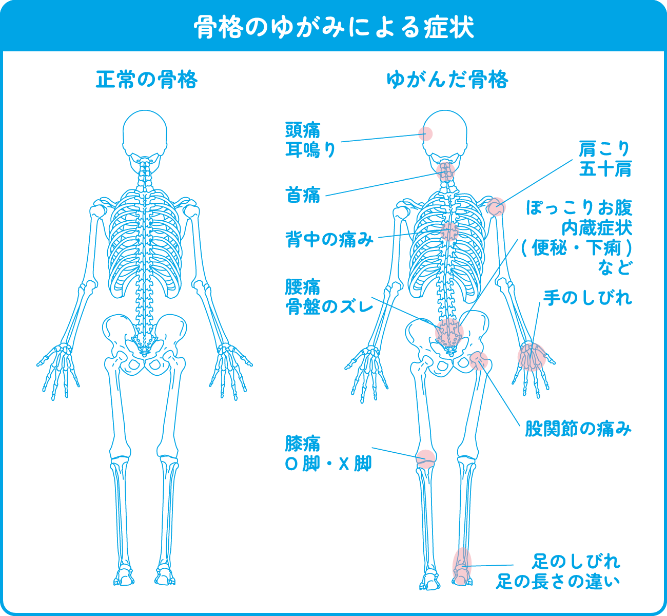 骨格のゆがみによる症状